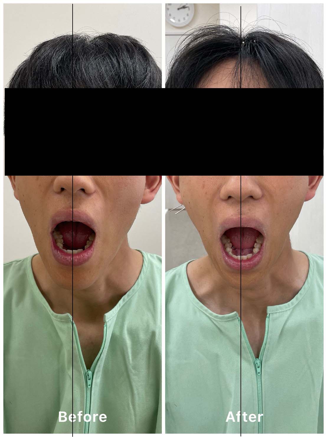 施術前後の比較（開口時）患者様B